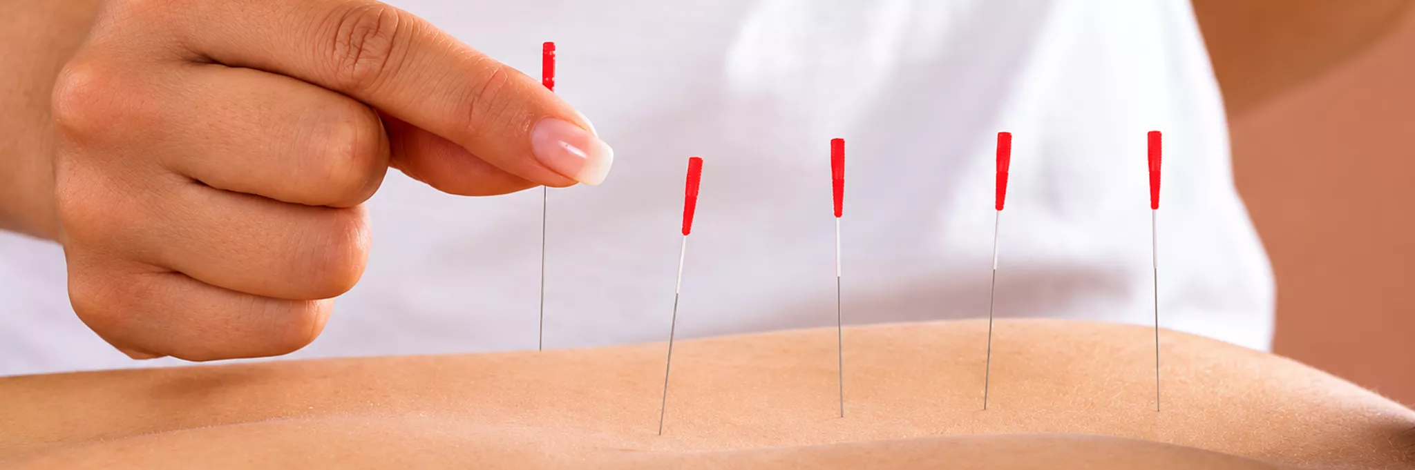 Dry Needling The Heeler Centre Hassocks