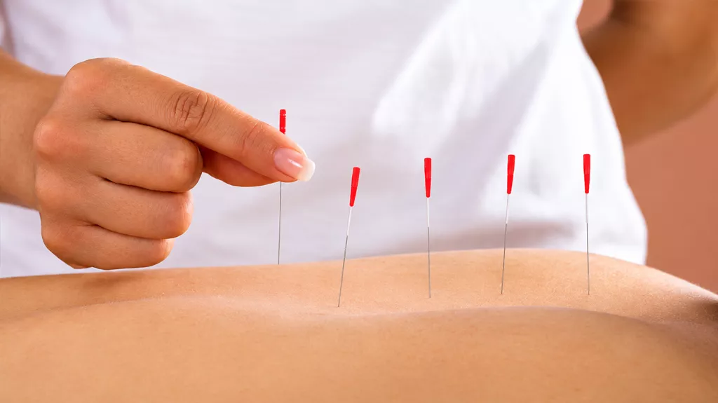 Dry Needling at The Heeler Centre Hassocks